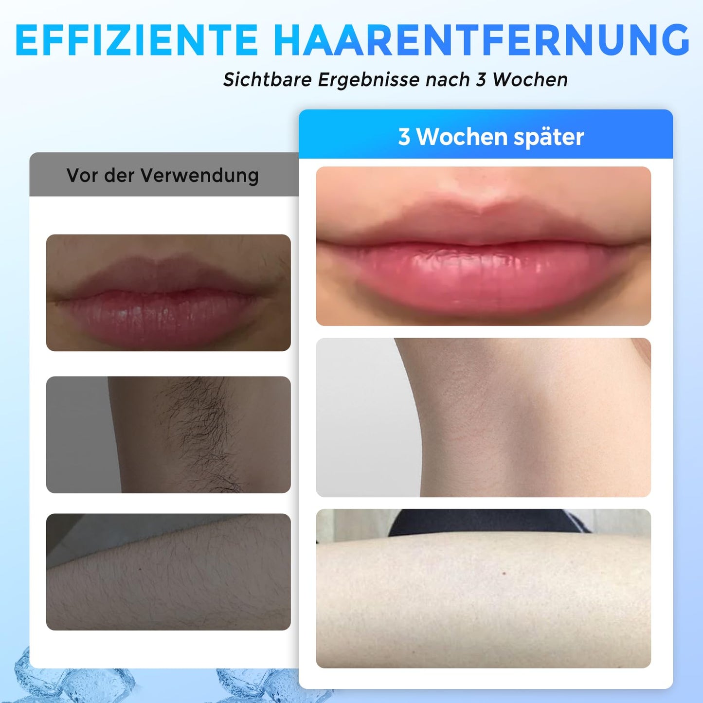 Atopskins IPL Haarentfernungsgerät, Schmerzlose Laser-Haarentfernung, 5 Intensitäten IPL Geräte Haarentfernung Und IPL Laser 2 in 1, Kann am Ganzen Körper Angewendet Werden, Inklusive IPL-Schutzbrille