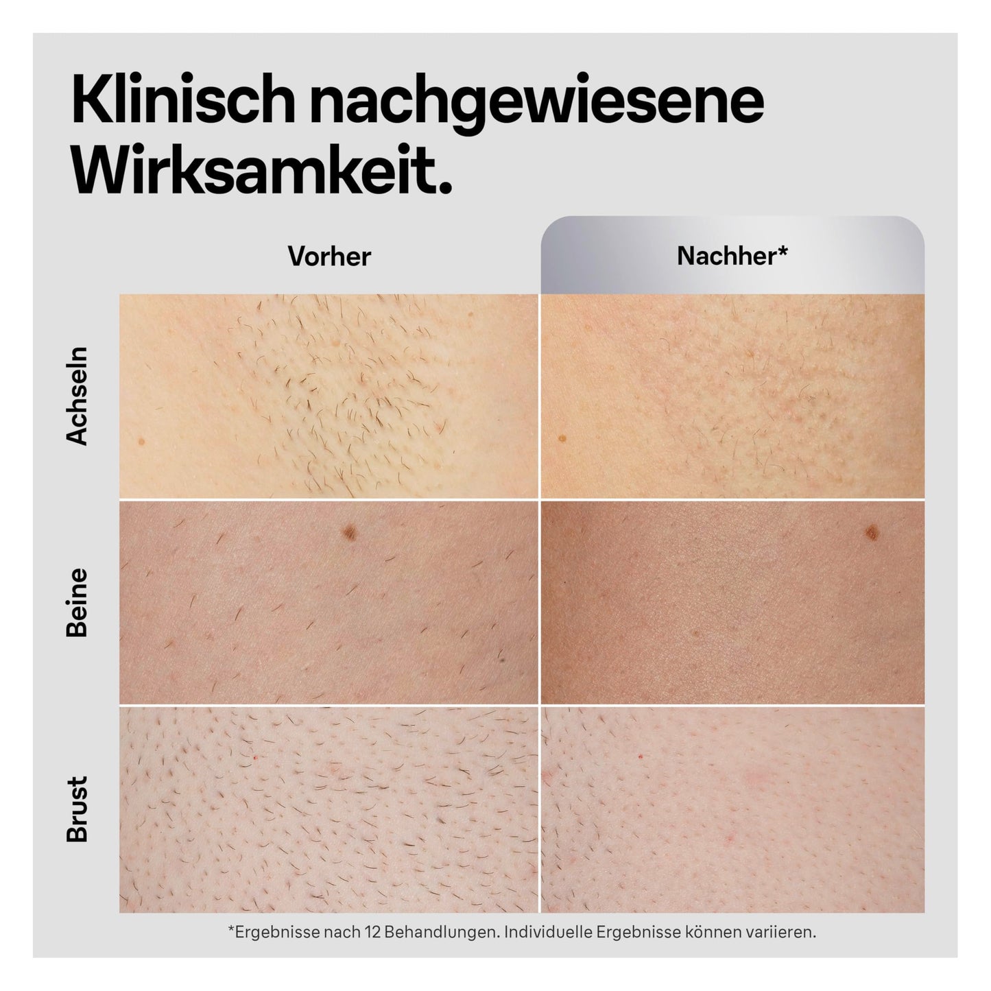 Braun IPL Silk Expert Pro 5 Haarentfernungsgerät Damen/Herren, 2 Aufsätze, sichtbare Haarentfernung, Designed In Germany, Venus Rasierer, Alternative zu Laser Haarentfernung, PL5157, weiß/gold